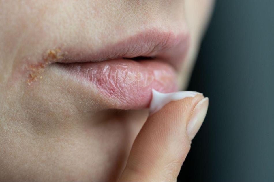 kobieta z opryszczką smarująca usta maścią leczniczą